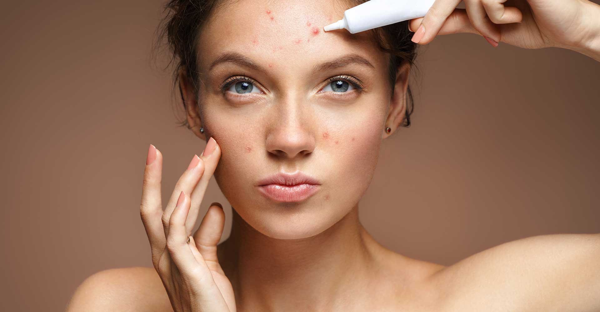 Mulher passando produto para tratar suas espinhas